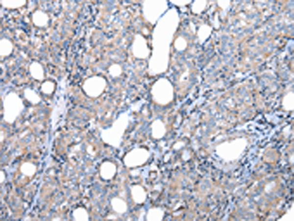 FKBPL Antibody - Immunohistochemistry of paraffin-embedded Human thyroid cancer tissue  using FKBPL Polyclonal Antibody at dilution of 1:50(×200)