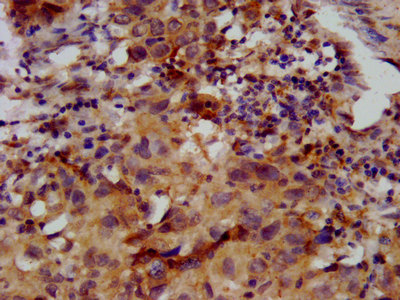 FKRP Antibody - Immunohistochemistry image at a dilution of 1:400 and staining in paraffin-embedded human ovarian cancer performed on a Leica BondTM system. After dewaxing and hydration, antigen retrieval was mediated by high pressure in a citrate buffer (pH 6.0) . Section was blocked with 10% normal goat serum 30min at RT. Then primary antibody (1% BSA) was incubated at 4 °C overnight. The primary is detected by a biotinylated secondary antibody and visualized using an HRP conjugated SP system.