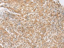 FKSG89 / MBOAT4 Antibody - Immunohistochemistry of paraffin-embedded Human cervical cancer tissue  using MBOAT4 Polyclonal Antibody at dilution of 1:30(×200)