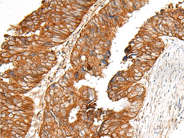 FKSG89 / MBOAT4 Antibody - Immunohistochemistry of paraffin-embedded Human colorectal cancer tissue  using MBOAT4 Polyclonal Antibody at dilution of 1:30(×200)