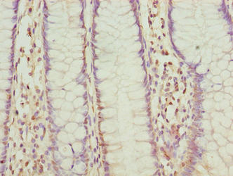 FLAD1 / FADS Antibody - Immunohistochemistry of paraffin-embedded human colon cancer using FLAD1 Antibody at dilution of 1:100