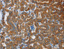 FLCN / Folliculin Antibody - Immunohistochemistry of paraffin-embedded Human liver cancer using FLCN Polyclonal Antibody at dilution of 1:40.