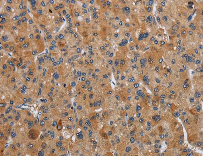 FLCN / Folliculin Antibody - Immunohistochemistry of paraffin-embedded Human liver cancer using FLCN Polyclonal Antibody at dilution of 1:40.