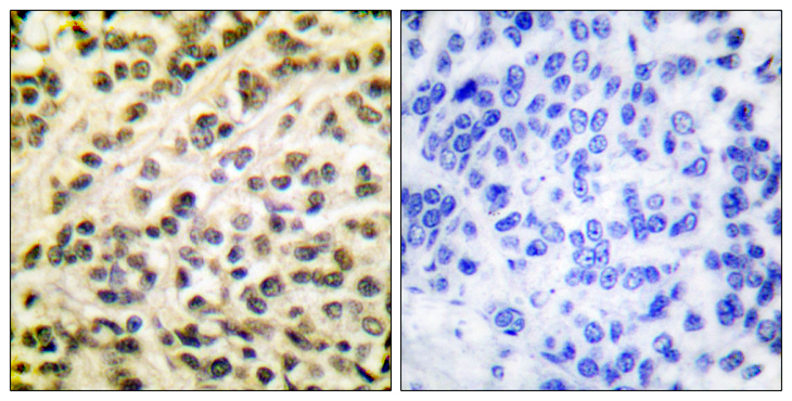 FLI1 Antibody - Immunohistochemistry analysis of paraffin-embedded human breast carcinoma tissue, using FLI1 Antibody. The picture on the right is blocked with the synthesized peptide.