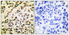 FLI1 Antibody - Immunohistochemistry analysis of paraffin-embedded human breast carcinoma tissue, using FLI1 Antibody. The picture on the right is blocked with the synthesized peptide.