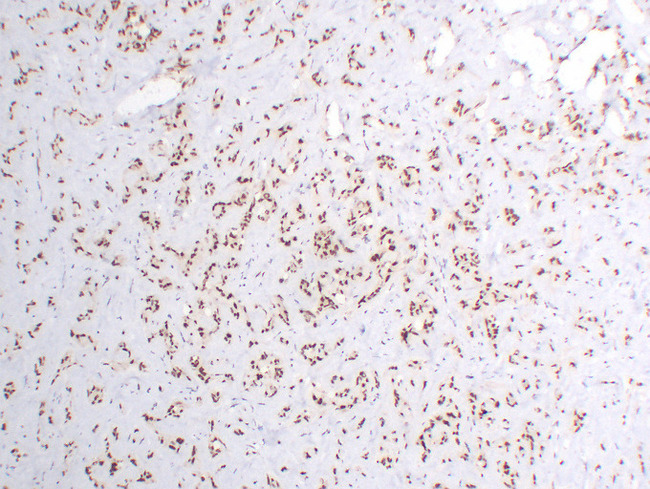 FLI1 Antibody - Hemangioendothelioma 1