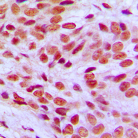 FLI1 Antibody - Immunohistochemical analysis of FLI1 staining in human breast cancer formalin fixed paraffin embedded tissue section. The section was pre-treated using heat mediated antigen retrieval with sodium citrate buffer (pH 6.0). The section was then incubated with the antibody at room temperature and detected using an HRP conjugated compact polymer system. DAB was used as the chromogen. The section was then counterstained with hematoxylin and mounted with DPX.