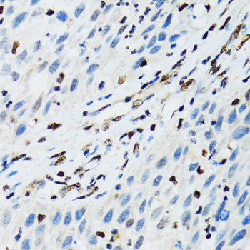 FLI1 Antibody - Immunohistochemistry of paraffin-embedded human lung cancer tissue.