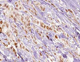 FLI1 Antibody - 1:100 staining human breast carcinoma tissue by IHC-P. The tissue was formaldehyde fixed and a heat mediated antigen retrieval step in citrate buffer was performed. The tissue was then blocked and incubated with the antibody for 1.5 hours at 22°C. An HRP conjugated goat anti-rabbit antibody was used as the secondary.