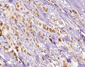 FLI1 Antibody - 1:100 staining human breast carcinoma tissue by IHC-P. The tissue was formaldehyde fixed and a heat mediated antigen retrieval step in citrate buffer was performed. The tissue was then blocked and incubated with the antibody for 1.5 hours at 22°C. An HRP conjugated goat anti-rabbit antibody was used as the secondary.