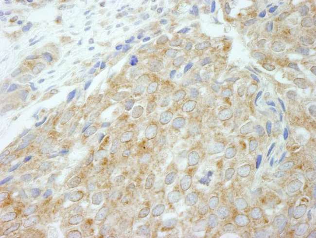 FLII / FLI Antibody - Detection of Human Flightless-1 by Immunohistochemistry. Sample: FFPE section of human breast carcinoma. Antibody: Affinity purified rabbit anti-Flightless-1 used at a dilution of 1:250.