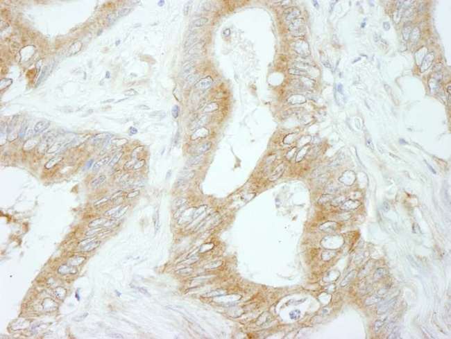FLII / FLI Antibody - Detection of Human Flightless-1 by Immunohistochemistry. Sample: FFPE section of human colon carcinoma. Antibody: Affinity purified rabbit anti-Flightless-1 used at a dilution of 1:250.