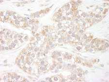 FLII / FLI Antibody - Detection of Human Flightless-1 by Immunohistochemistry. Sample: FFPE section of human breast carcinoma. Antibody: Affinity purified rabbit anti-Flightless-1 used at a dilution of 1:200 (1 Detection: DAB.