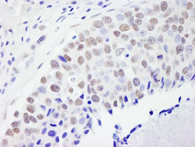 FLJ12529 / CPSF7 Antibody - Detection of Human CPSF59 by Immunohistochemistry. Sample: FFPE section of human breast carcinoma. Antibody: Affinity purified rabbit anti-CPSF59 used at a dilution of 1:500 (2 ug/ml). Detection: DAB.