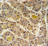 FLJ20309 Antibody - IN80D Antibody IHC of formalin-fixed and paraffin-embedded human hepatocarcinoma followed by peroxidase-conjugated secondary antibody and DAB staining.