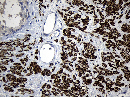 FLJ33360 Antibody - Immunohistochemical staining of paraffin-embedded Carcinoma of Human prostate tissue using anti-FLJ33360 mouse monoclonal antibody. (Heat-induced epitope retrieval by 1mM EDTA in 10mM Tris buffer. (pH8.5) at 120°C for 3 min. (1:500)