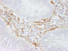FLNA / Filamin A Antibody - Detection of Human Filamin A by Immunohistochemistry. Sample: FFPE section of human colon carcinoma. Antibody: Affinity purified rabbit anti-Filamin A used at a dilution of 1:250.