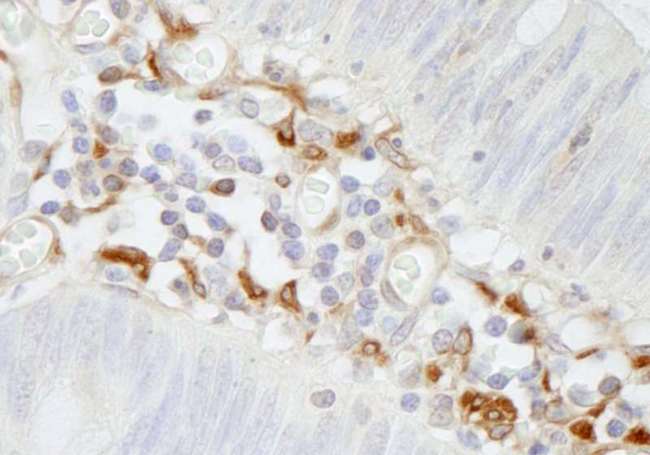 FLNA / Filamin A Antibody - Detection of Human Filamin A by Immunohistochemistry. Sample: FFPE section of human colon carcinoma. Antibody: Affinity purified rabbit anti-Filamin A used at a dilution of 1:250.