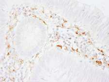 FLNA / Filamin A Antibody - Detection of Human Filamin A by Immunohistochemistry. Sample: FFPE section of human colon carcinoma. Antibody: Affinity purified rabbit anti-Filamin A used at a dilution of 1:1000 (0.2 Detection: DAB.