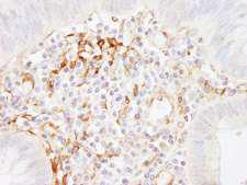 FLNA / Filamin A Antibody - Detection of Human Filamin A by Immunohistochemistry. Sample: FFPE section of human colon carcinoma. Antibody: Affinity purified rabbit anti-Filamin A used at a dilution of 1:1000 (0.2 Detection: DAB.