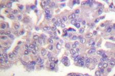 FLNA / Filamin A Antibody - IHC of Filamin A (R2146) pAb in paraffin-embedded human breast carcinoma tissue.