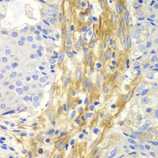 FLNA / Filamin A Antibody - Immunohistochemistry of paraffin-embedded human oophoroma tissue.