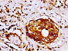 FLNA / Filamin A Antibody - Immunohistochemistry image of paraffin-embedded human breast cancer at a dilution of 1:100