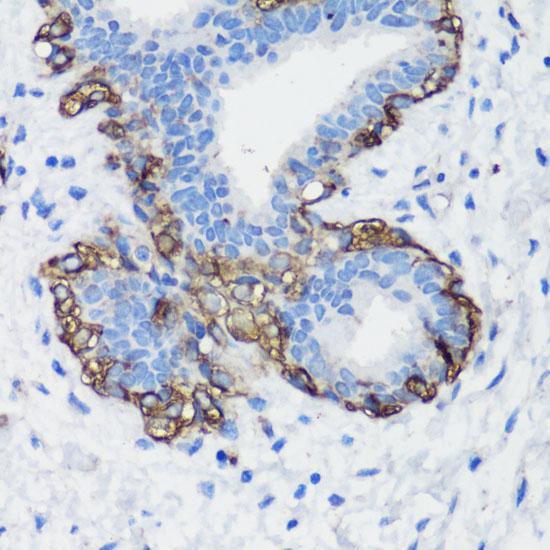 FLNA / Filamin A Antibody - Immunohistochemistry of paraffin-embedded Human breast cancer using FLNA Polyclonal Antibody at dilution of 1:100 (40x lens).