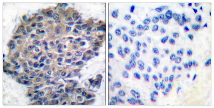 FLNA / Filamin A Antibody - Immunohistochemistry analysis of paraffin-embedded human breast carcinoma, using Filamin A (Phospho-Ser2152) Antibody. The picture on the right is blocked with the phospho peptide.