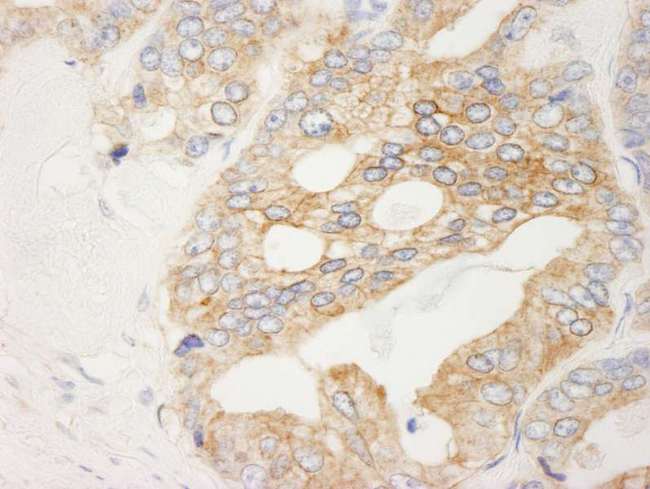 FLNB / TAP Antibody - Detection of Human Filamin B by Immunohistochemistry. Sample: FFPE section of human prostate carcinoma. Antibody: Affinity purified rabbit anti-Filamin B used at a dilution of 1:200 (1 Detection: DAB.