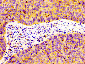 FLOT1 / Flotillin 1 Antibody - Immunohistochemistry image at a dilution of 1:100 and staining in paraffin-embedded human cervical cancer performed on a Leica BondTM system. After dewaxing and hydration, antigen retrieval was mediated by high pressure in a citrate buffer (pH 6.0) . Section was blocked with 10% normal goat serum 30min at RT. Then primary antibody (1% BSA) was incubated at 4 °C overnight. The primary is detected by a biotinylated secondary antibody and visualized using an HRP conjugated SP system.