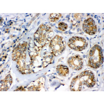 FLOT2 / Flotillin 2 Antibody - Flotillin 2 antibody IHC-paraffin. IHC(P): Human Mammary Cancer Tissue.