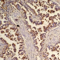 FLOT2 / Flotillin 2 Antibody - Immunohistochemical analysis of Flotillin 2 staining in human lung cancer formalin fixed paraffin embedded tissue section. The section was pre-treated using heat mediated antigen retrieval with sodium citrate buffer (pH 6.0). The section was then incubated with the antibody at room temperature and detected using an HRP conjugated compact polymer system. DAB was used as the chromogen. The section was then counterstained with hematoxylin and mounted with DPX.