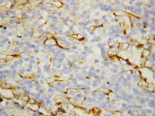 FLT1 / VEGFR1 Antibody - FLKT1 / FLT-1 / VEGFR1 antibody. IHC(P): Human Breast Cancer Tissue.