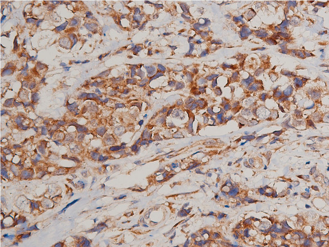 FLT1 / VEGFR1 Antibody - 1:200 staining human breast carcinoma tissue by IHC-P. The tissue was formaldehyde fixed and a heat mediated antigen retrieval step in citrate buffer was performed. The tissue was then blocked and incubated with the antibody for 1.5 hours at 22°C. An HRP conjugated goat anti-rabbit antibody was used as the secondary.
