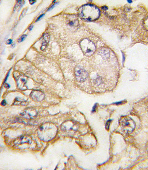 FLT4 / VEGFR3 Antibody - Formalin-fixed and paraffin-embedded human lung carcinoma tissue reacted with VGFR3 Monoclonal Antibody , which was peroxidase-conjugated to the secondary antibody, followed by DAB staining. This data demonstrates the use of this antibody for immunohistochemistry; clinical relevance has not been evaluated.
