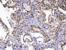 FLT4 / VEGFR3 Antibody - IHC testing of FFPE human lung cancer tissue with VEGFR3 antibody at 1ug/ml. Required HIER: steam section in pH6 citrate buffer for 20 min and allow to cool prior to testing.