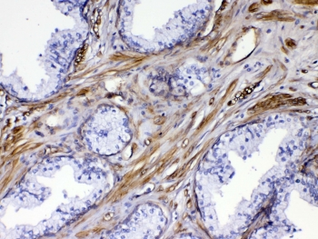 FLT4 / VEGFR3 Antibody - IHC testing of FFPE human prostate cancer tissue with VEGFR3 antibody at 1ug/ml. Required HIER: steam section in pH6 citrate buffer for 20 min and allow to cool prior to testing.