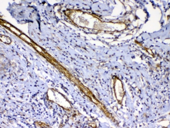 FLT4 / VEGFR3 Antibody - IHC testing of FFPE human breast cancer tissue with VEGFR3 antibody at 1ug/ml. Required HIER: steam section in pH6 citrate buffer for 20 min and allow to cool prior to testing.