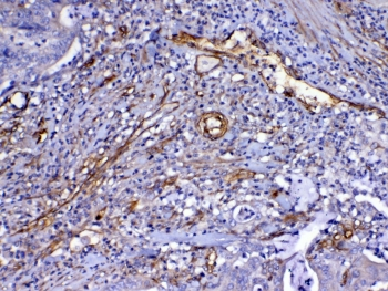 FLT4 / VEGFR3 Antibody - IHC testing of FFPE human colon cancer tissue with VEGFR3 antibody at 1ug/ml. Required HIER: steam section in pH6 citrate buffer for 20 min and allow to cool prior to testing.