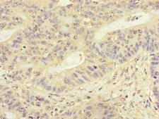 FMNL3 Antibody - Immunohistochemistry of paraffin-embedded human colon cancer at dilution of 1:100