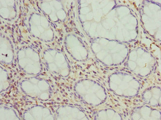 FMO1 Antibody - Immunohistochemistry of paraffin-embedded human colon cancer at dilution 1:100