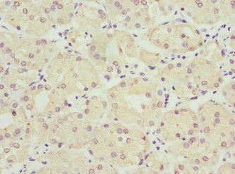 FMO1 Antibody - Immunohistochemistry of paraffin-embedded human gastric cancer at dilution 1:100