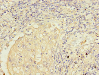 FMO2 Antibody - Immunohistochemistry of paraffin-embedded human lung cancer at dilution 1:100