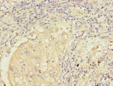 FMO2 Antibody - Immunohistochemistry of paraffin-embedded human lung cancer at dilution 1:100