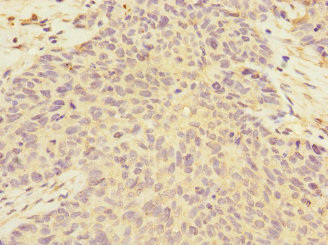 FMO2 Antibody - Immunohistochemistry of paraffin-embedded human ovarian cancer at dilution 1:100