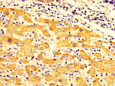 FMO3 Antibody - Immunohistochemistry image at a dilution of 1:300 and staining in paraffin-embedded human liver cancer performed on a Leica BondTM system. After dewaxing and hydration, antigen retrieval was mediated by high pressure in a citrate buffer (pH 6.0) . Section was blocked with 10% normal goat serum 30min at RT. Then primary antibody (1% BSA) was incubated at 4 °C overnight. The primary is detected by a biotinylated secondary antibody and visualized using an HRP conjugated SP system.