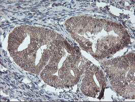 FMR1 / FMRP Antibody - IHC of paraffin-embedded Adenocarcinoma of Human endometrium tissue using anti-FMR1 mouse monoclonal antibody.
