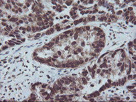 FMR1 / FMRP Antibody - IHC of paraffin-embedded Adenocarcinoma of Human ovary tissue using anti-FMR1 mouse monoclonal antibody. (Heat-induced epitope retrieval by 10mM citric buffer, pH6.0, 100C for 10min).