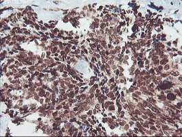 FMR1 / FMRP Antibody - IHC of paraffin-embedded Adenocarcinoma of Human breast tissue using anti-FMR1 mouse monoclonal antibody.